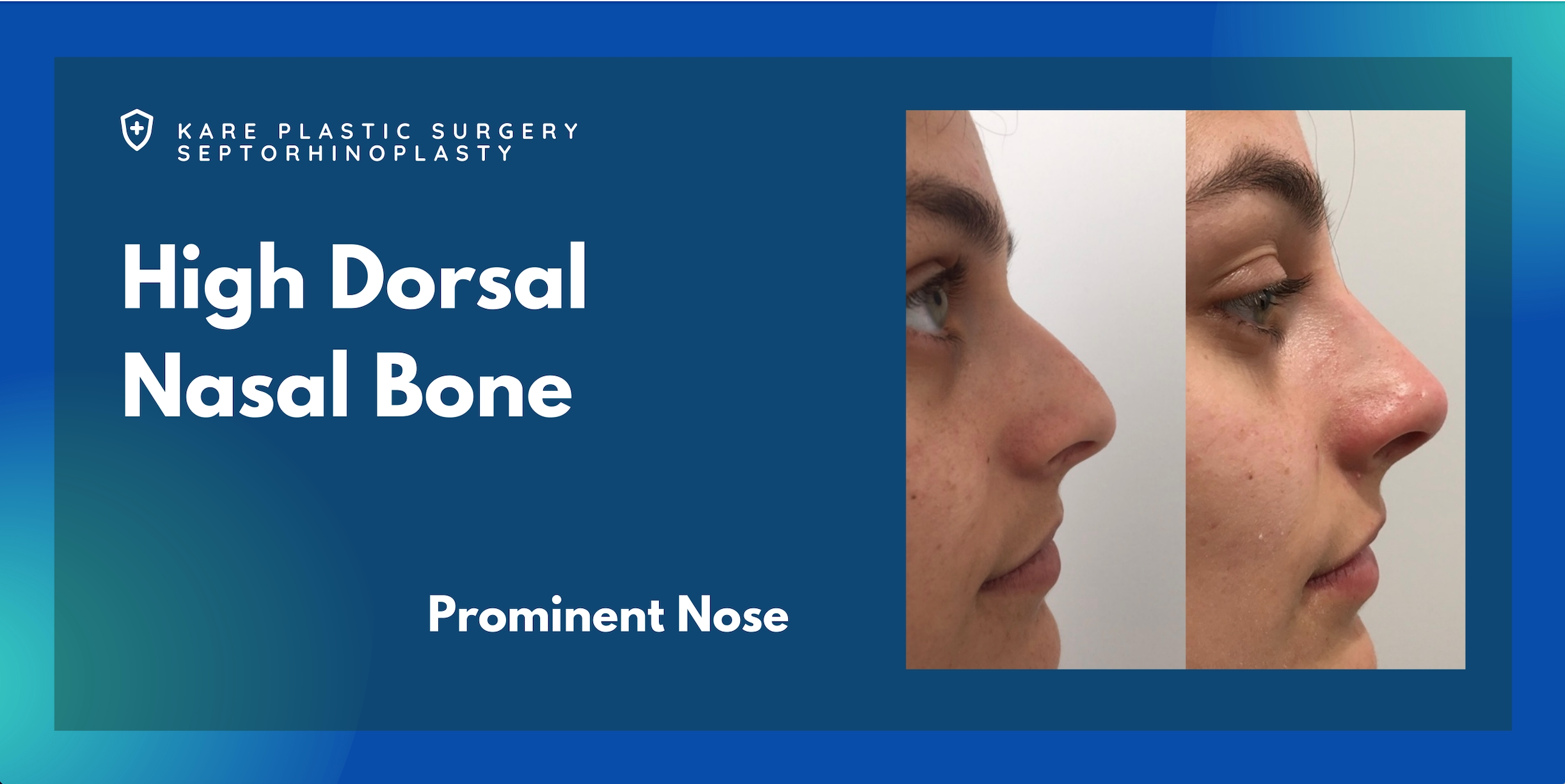 Nose Surgery Rhinoplasty in Santa Monica