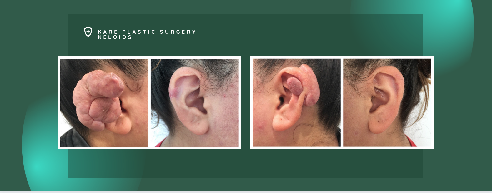 Keloid removal before and after in Los Angeles for scar removal
