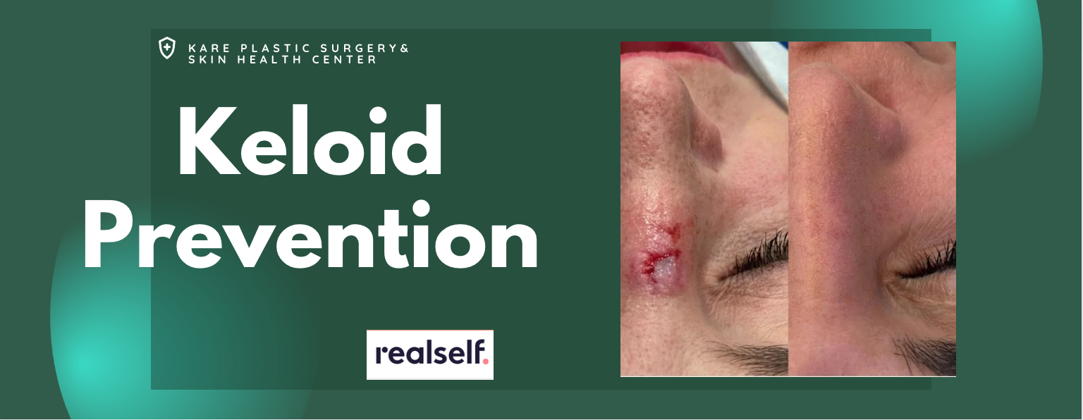 Keloid scar prevention, top dermatologist in los angeles for keloids