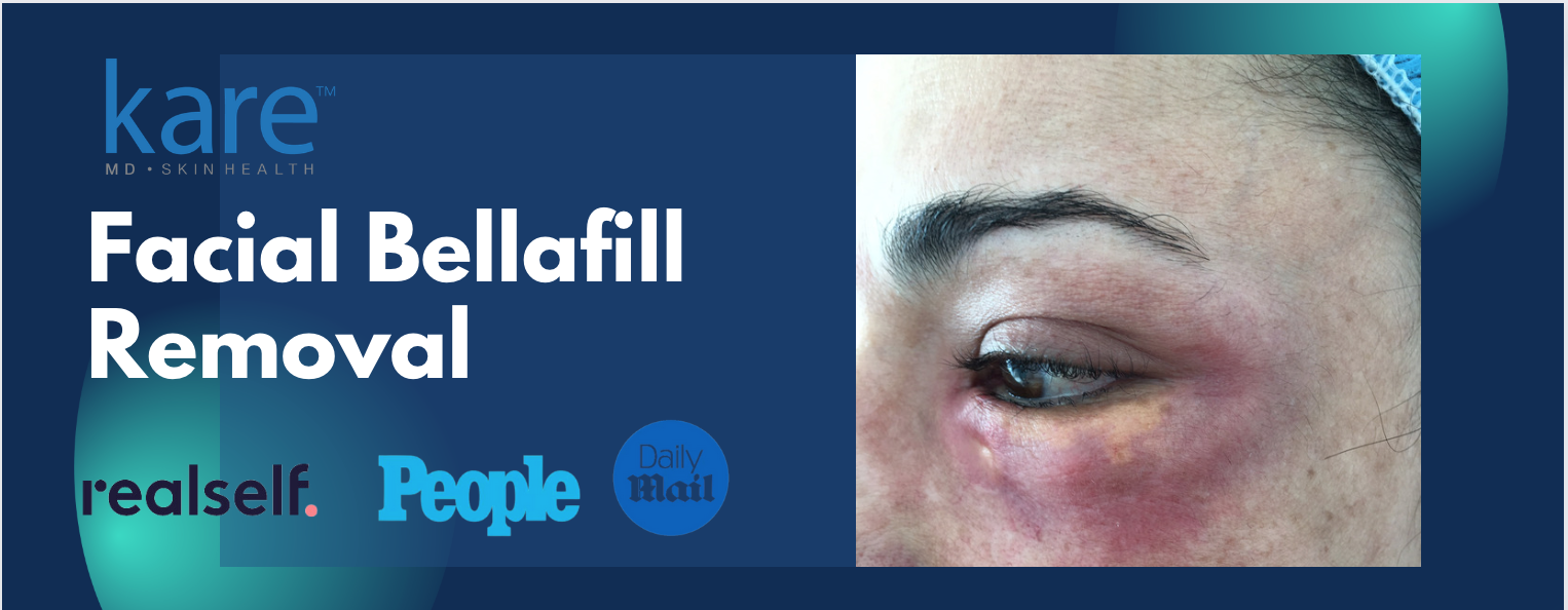 Bellafill removal surgery in Los Angeles with Dr. Karamanoukian