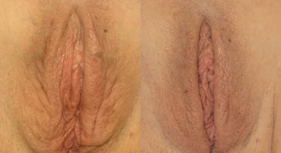 ThermiVA Before and After Kare Plastic Surgery LAbiaplasty and Vaginoplasty Los Angeles