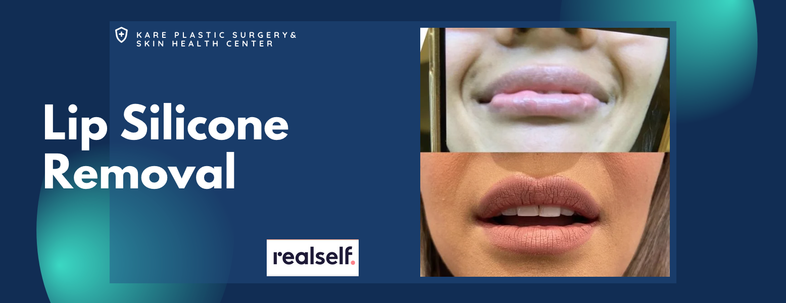 Silicone Lip Lift Surgery in Los Angeles