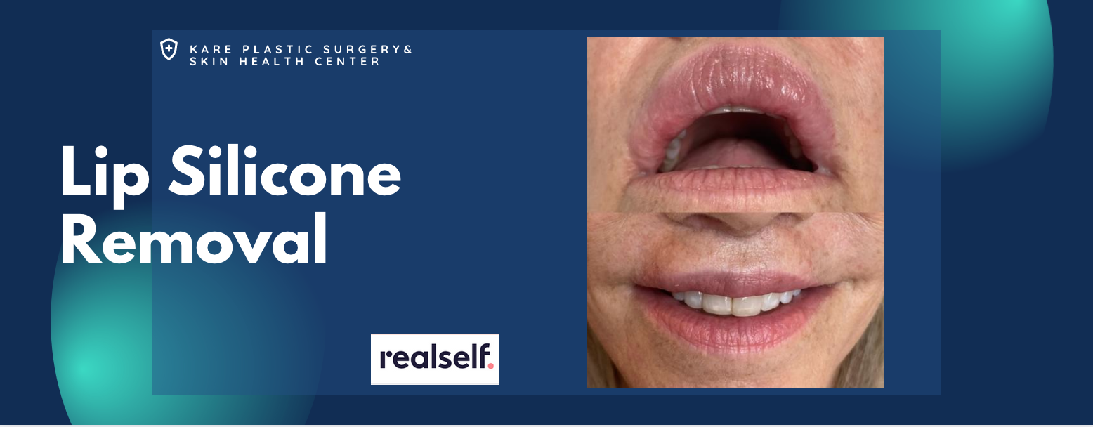 Removal of silicone and PMMA from the lips