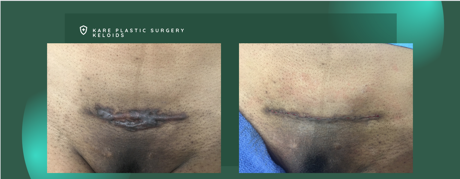 Keloid and Surgery Scar Revision Surgery in los angeles