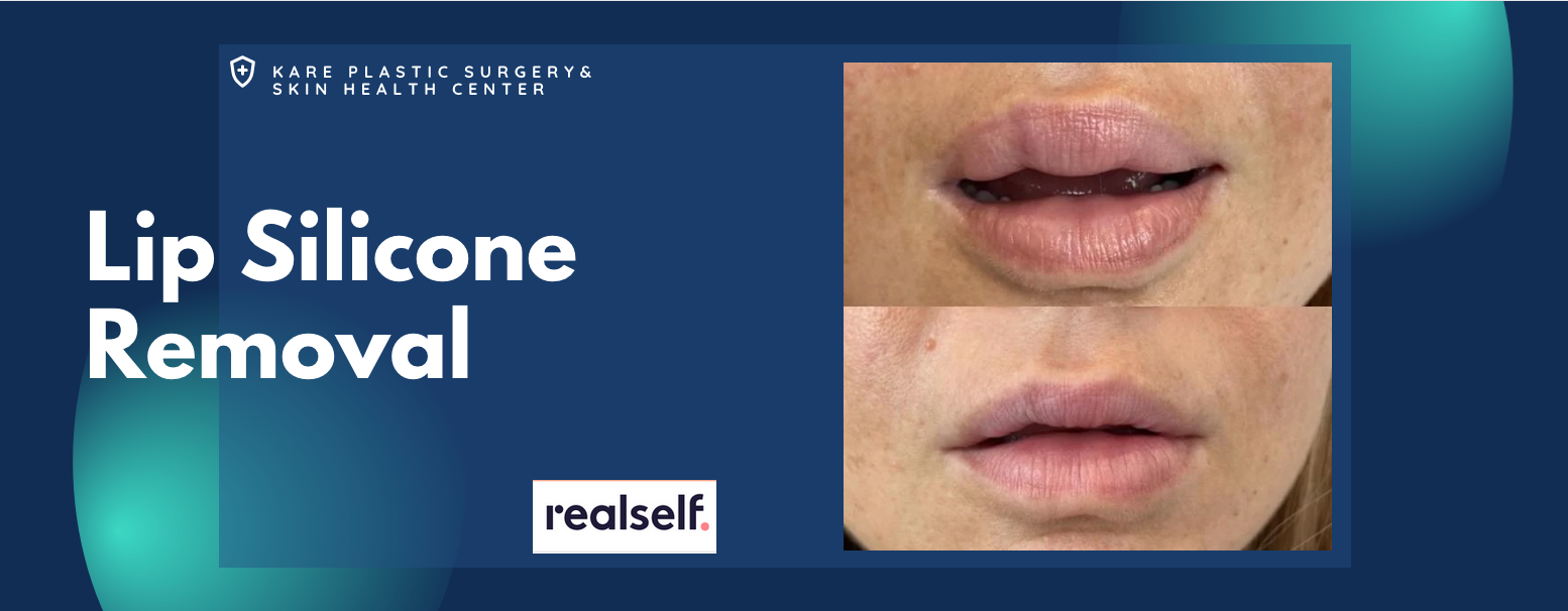 Silicone and Bellafill Removal from the face and lips in los angeles