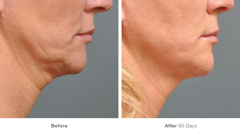 Neck lift and Face lift in Santa Monica at Kare Plastic Surgery
