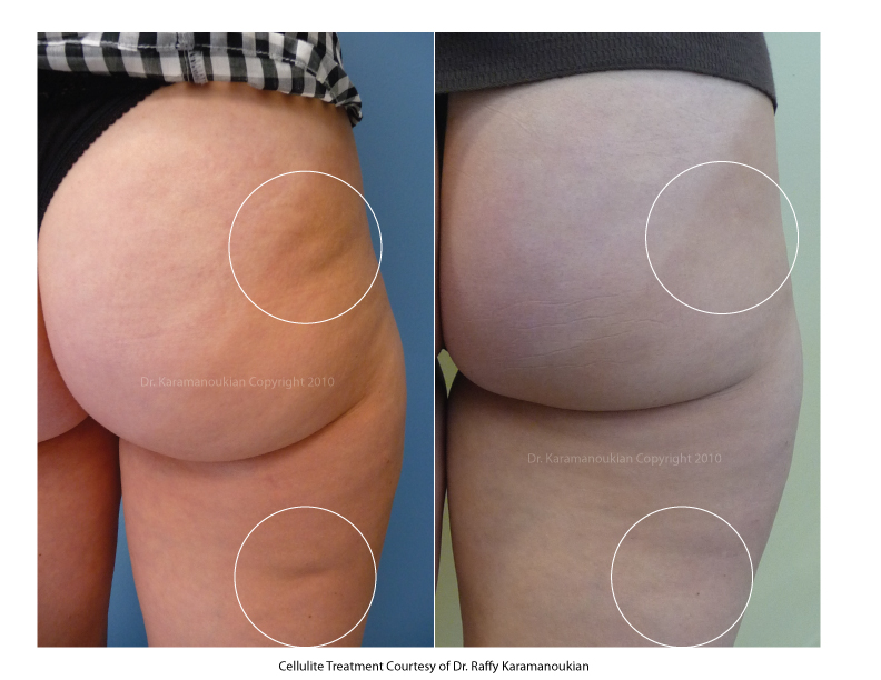 Brazilian Cellulite Treatment vs. Cellfina in Santa Monica