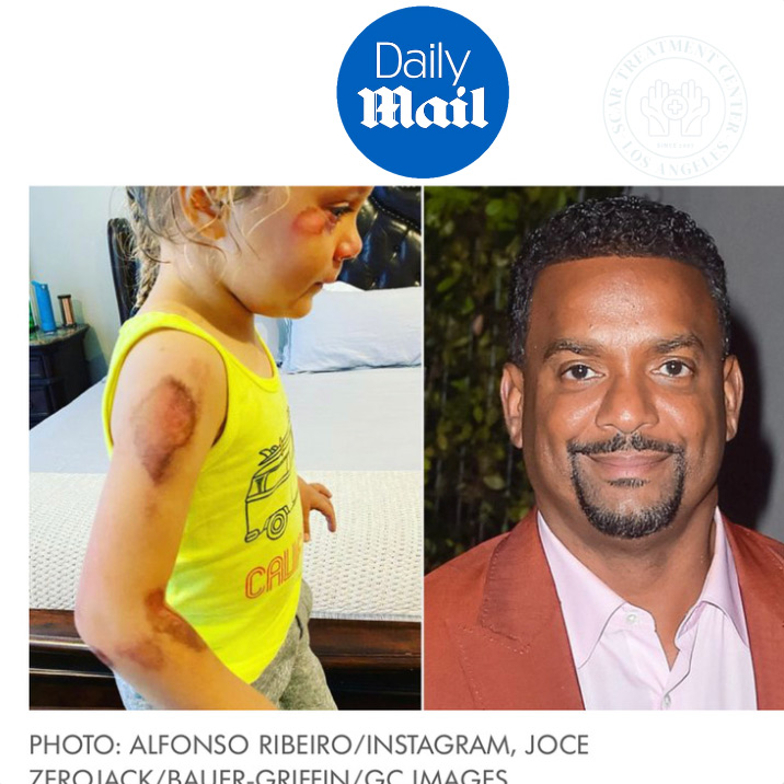Alfonso Ribeiro Daily Mail article showing daughter Ava emergency surgery treated by Dr. Karamanoukian at Kare Plastic Surgery Los Angeles Santa Monica