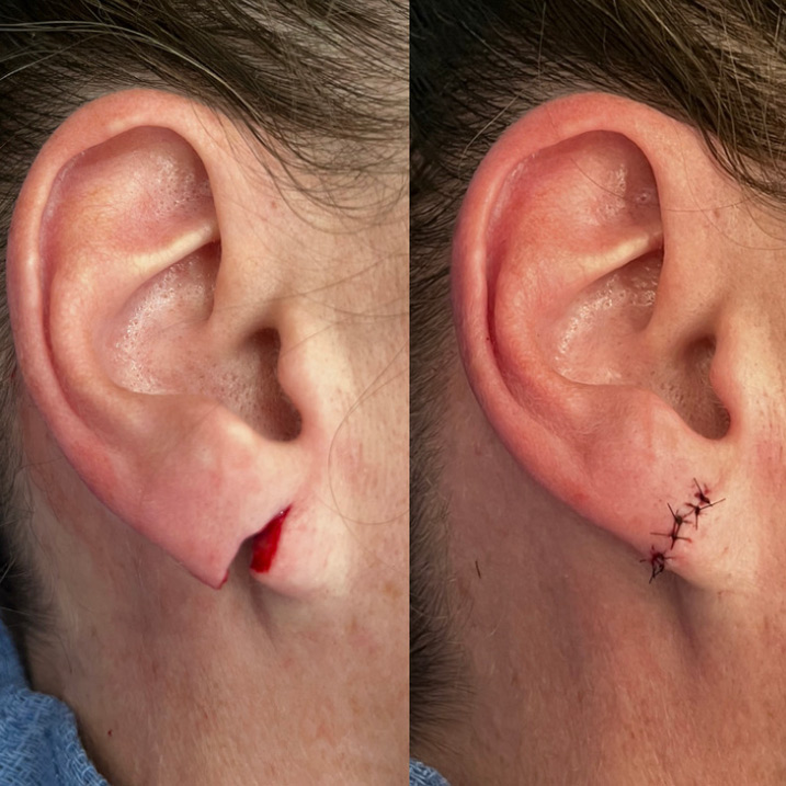 Earlobe repair before and after by Dr. Raffy Karamanoukian at Kare Plastic Surgery Santa Monica Los Angeles — torn split earlobe with active bleeding repaired with precise multi-stitch closure restoring natural earlobe anatomy immediately