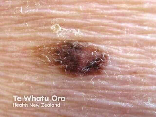 Close-up clinical photograph of melanoma on skin showing classic superficial spreading melanoma features including asymmetric irregular shape notched scalloped border multiple shades of brown black and reddish brown color variation and irregular diameter — educational reference image courtesy Te Whatu Ora Health New Zealand