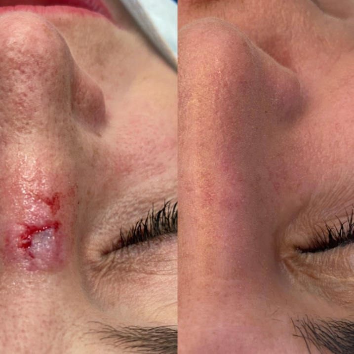 Before and after facial skin cancer reconstruction and scar repair by Dr. Raffy Karamanoukian at Kare Plastic Surgery Los Angeles
