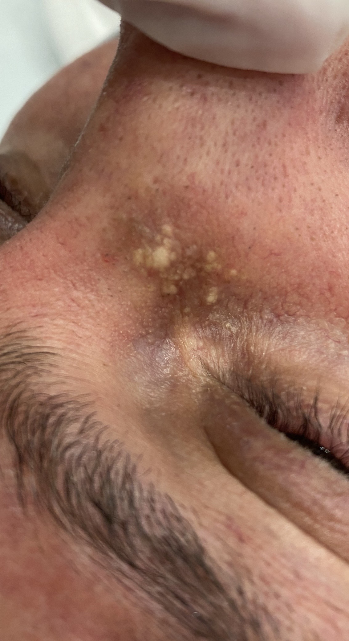 Xanthelasma palpebrarum and milia periorbital eyelid skin treated at Kare Plastic Surgery Los Angeles Santa Monica by board-certified dermatologist Dr. Tiffany Sierro showing yellowish-white cholesterol deposits and associated milia keratin cysts on the medial lower eyelid and periorbital skin evaluated for TCA peel laser treatment and minimally scarring extraction