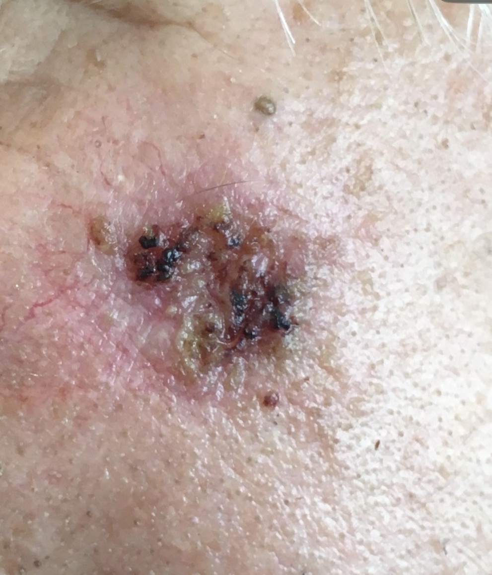Advanced pigmented skin cancer lesion showing irregular borders, multi-focal dark pigmentation, central ulceration, and surrounding erythema — clinical example from Kare Plastic Surgery skin cancer screening in Santa Monica Los Angeles
