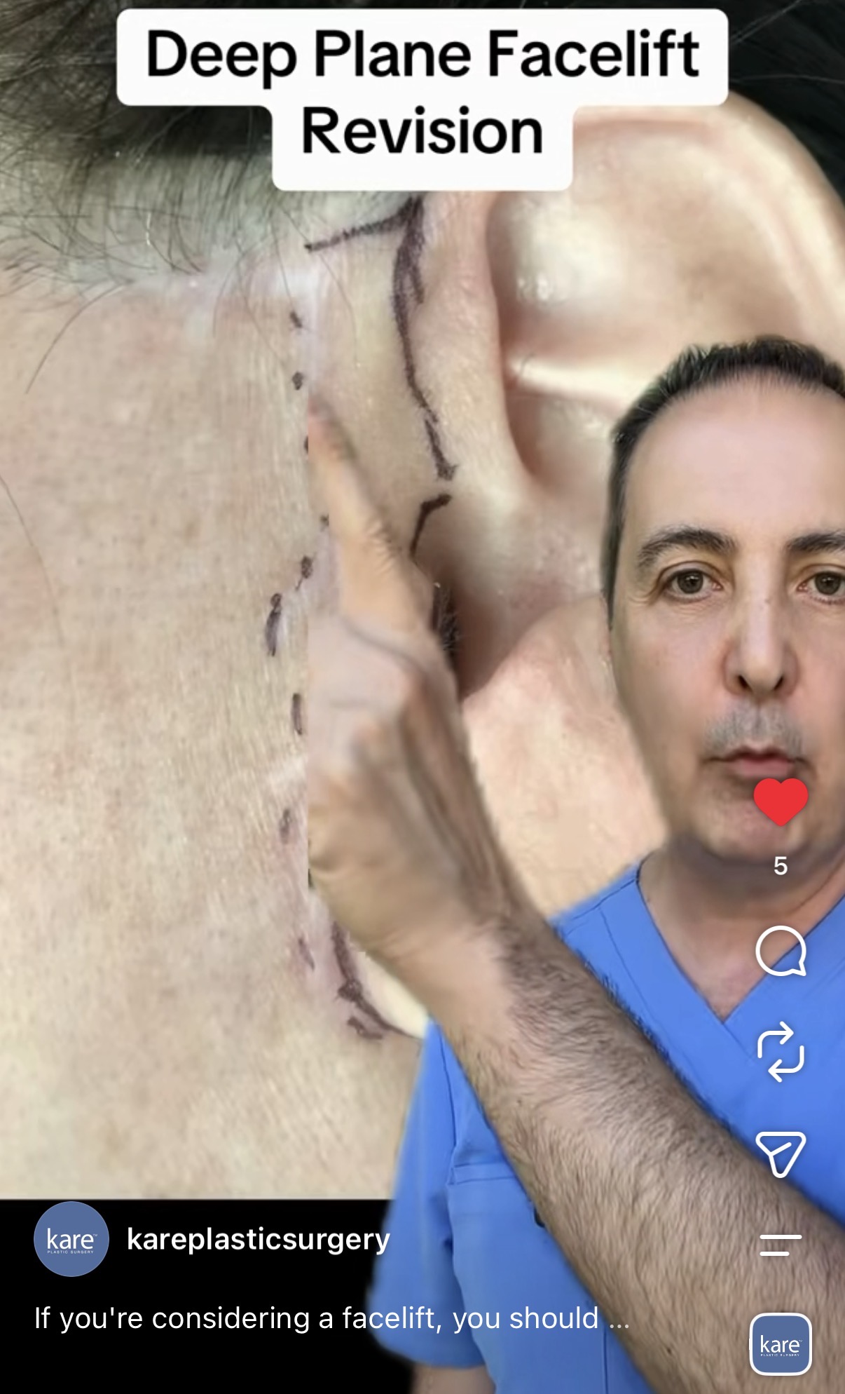 Instagram video from kareplasticsurgery showing Dr. Raffy Karamanoukian examining a facelift incision with sutures behind the ear during a deep plane facelift revision consultation at Kare Plastic Surgery Los Angeles, showing the post-auricular scar location and incision markings
