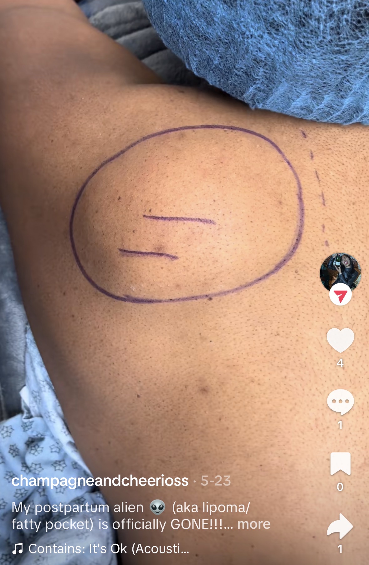 Pre-operative lipoma marking on patient back — surgical planning by Dr. Karamanoukian at Kare Plastic Surgery Los Angeles — large back lipoma circled with planned minimal incision marked