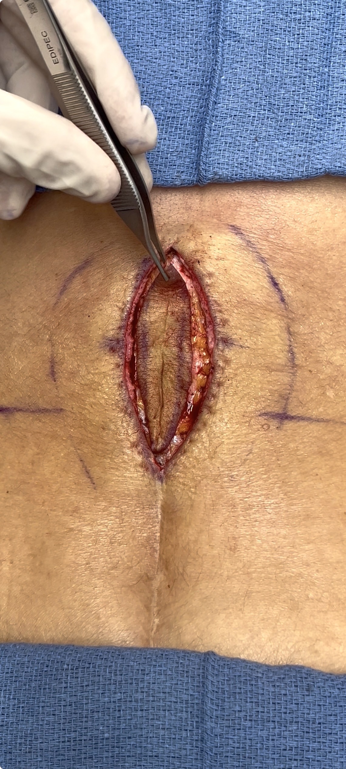Before photo showing hypertrophic raised spinal surgery scar with surgical excision markings by Dr. Raffy Karamanoukian at Kare Plastic Surgery Los Angeles, demonstrating the type of back surgery scar treated before excision