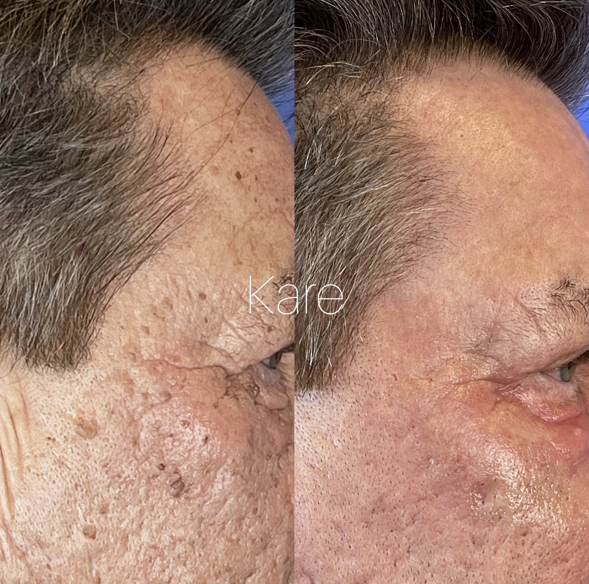 CO2 laser resurfacing before and after — temporal face and cheek area — acne scars, sun damage, and irregular skin texture dramatically improved by CO2 laser treatment by Dr. Raffy Karamanoukian at Kare Plastic Surgery Santa Monica Los Angeles