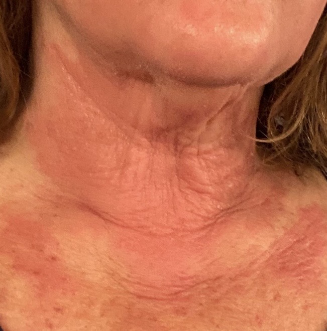 Severe chronic eczema atopic dermatitis on neck and chest photographed at Kare Skin Health Center Santa Monica by Dr. Tiffany Sierro showing erythematous lichenified excoriated skin with widespread inflammation and skin thickening classic presentation of chronic atopic dermatitis requiring dermatologist management