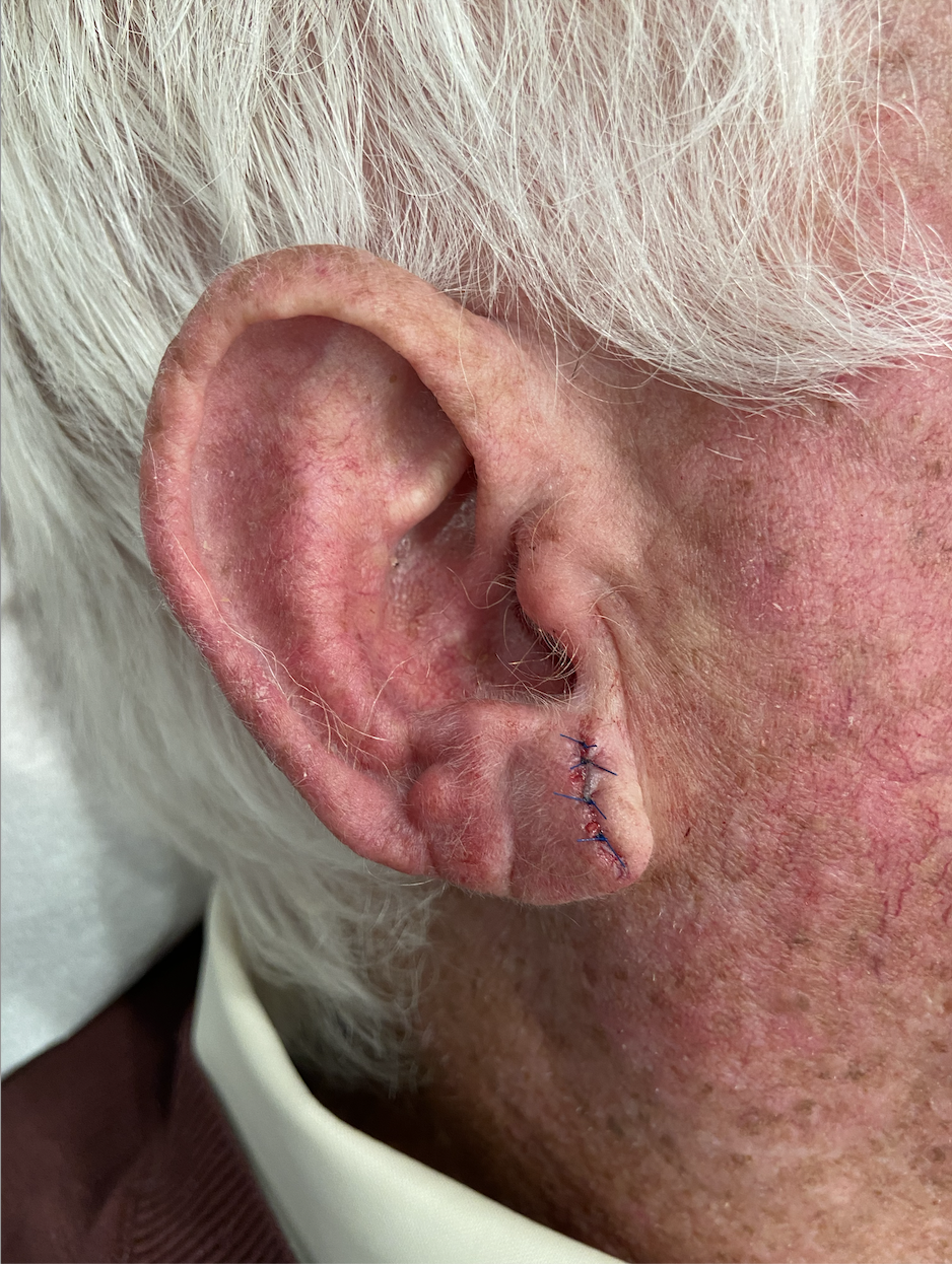 After squamous cell carcinoma excision from earlobe at the Kare Skin Cancer Center Santa Monica by Dr. Tiffany Sierro board-certified dermatologist showing clean surgical excision with precise fine suture closure on earlobe demonstrating minimally scarring technique and complete tumor removal with appropriate margins