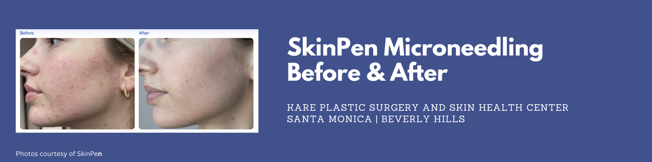 skinpen microneedling before and after for acne scars in los angeles