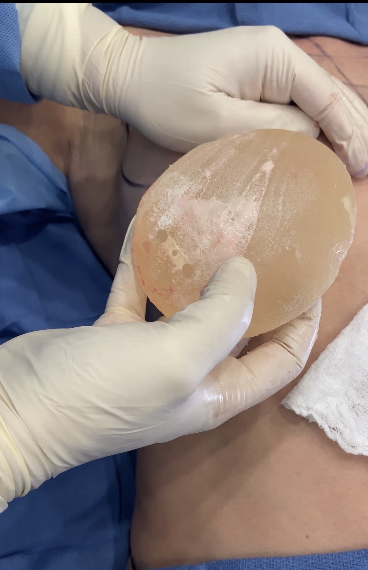 Intraoperative removal of problematic breast implant with capsular contracture surface biofilm and infection at Kare Plastic Surgery Los Angeles by board-certified plastic surgeon Dr. Raffy Karamanoukian showing explanted silicone gel breast implant with surface adherent inflammatory material and visible implant surface changes consistent with biofilm contamination and capsular contracture requiring total capsulectomy and implant removal