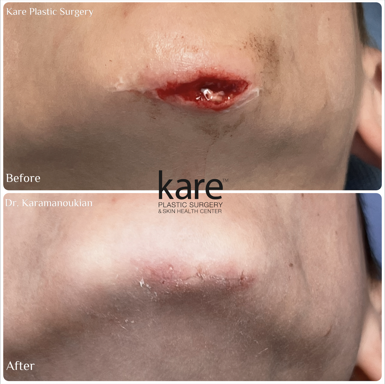 Before and after photo of a child with a deep chin laceration treated at Kare Plastic Surgery Los Angeles by Dr. Raffy Karamanoukian, showing precise wound closure and early healing result after pediatric facial laceration repair