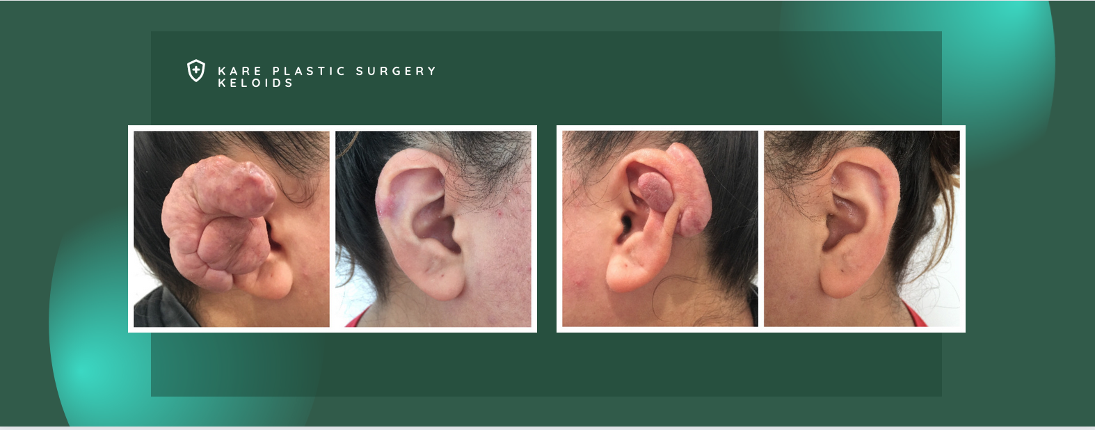 Ear keloid removal in Los Angeles