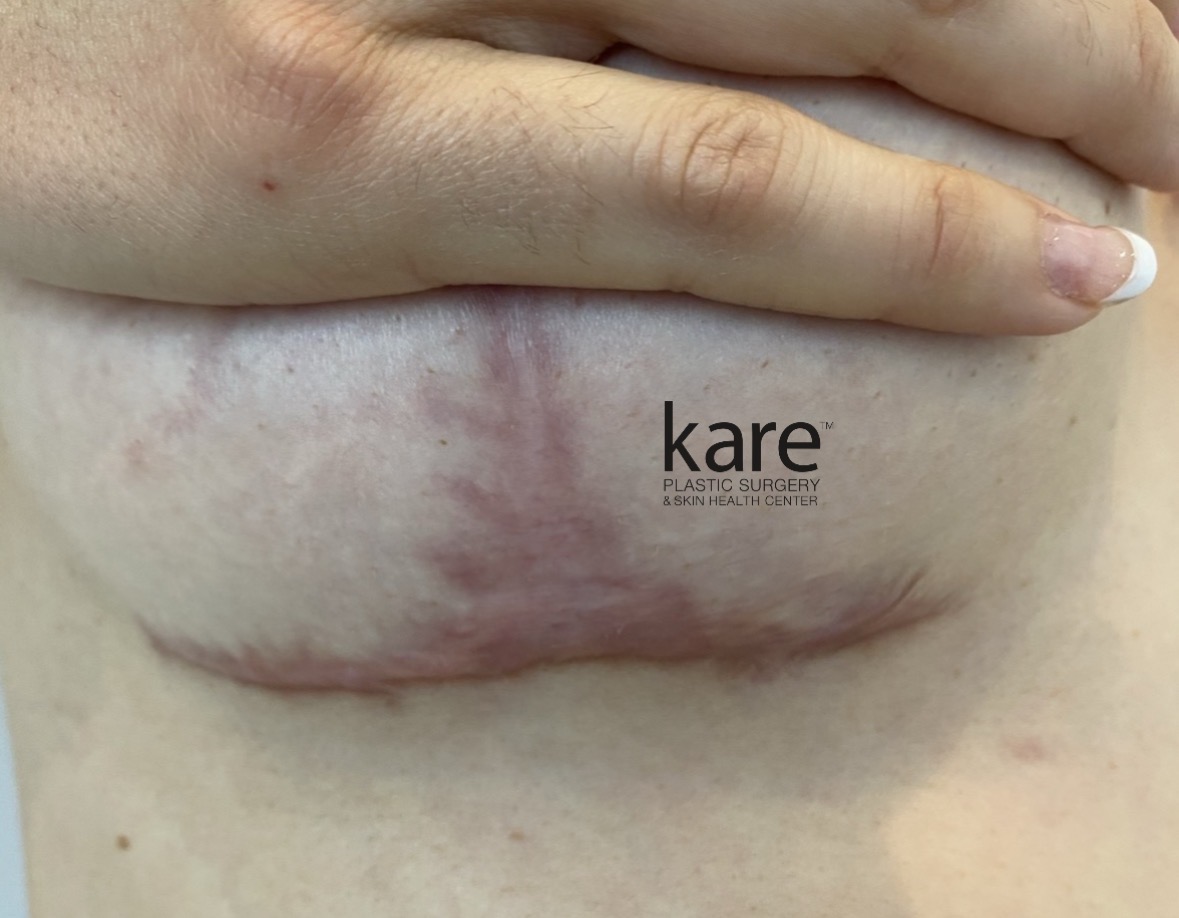 Hypertrophic and keloid breast lift scar along the inframammary fold following mastopexy, treated at Kare Plastic Surgery Los Angeles by Dr. Raffy Karamanoukian