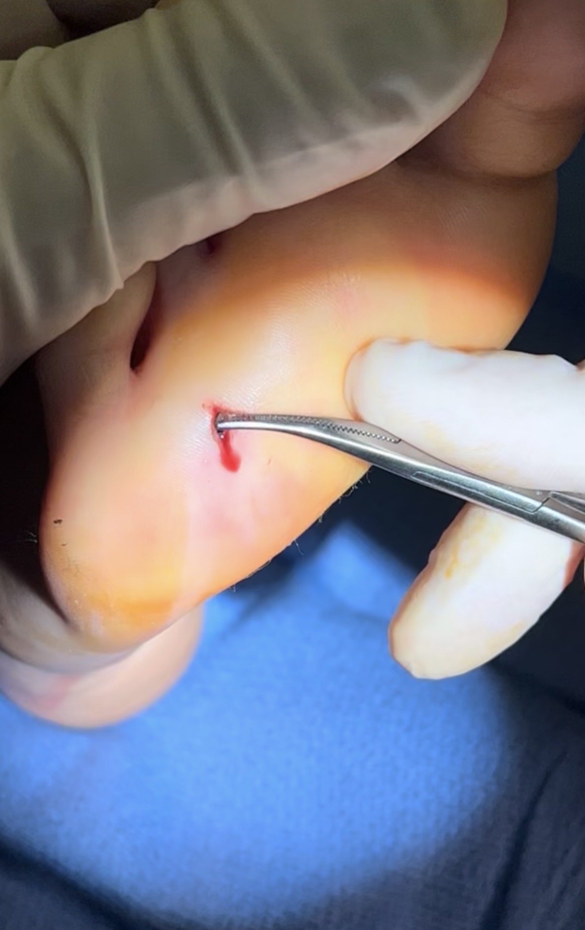 Surgical splinter removal from foot in Los Angeles by Dr. Raffy Karamanoukian board-certified plastic surgeon at Kare Plastic Surgery showing surgical forceps extracting embedded foreign object from plantar surface of foot under local anesthesia with sterile surgical technique