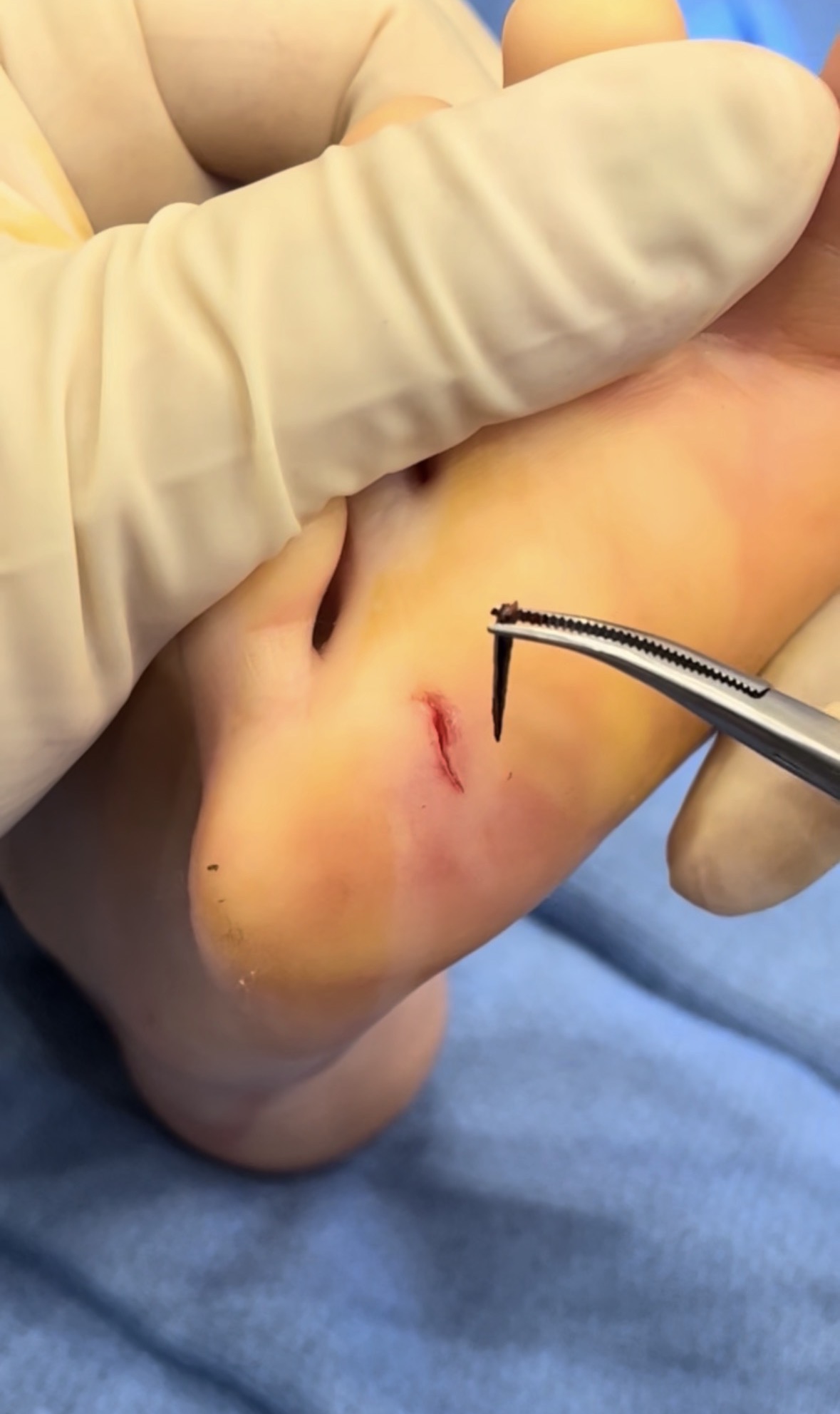 Foreign object removal from foot in Los Angeles by Dr. Raffy Karamanoukian plastic surgeon at Kare Plastic Surgery demonstrating successful extraction of embedded foreign body using curved surgical hemostatic forceps with complete removal and clean wound margins