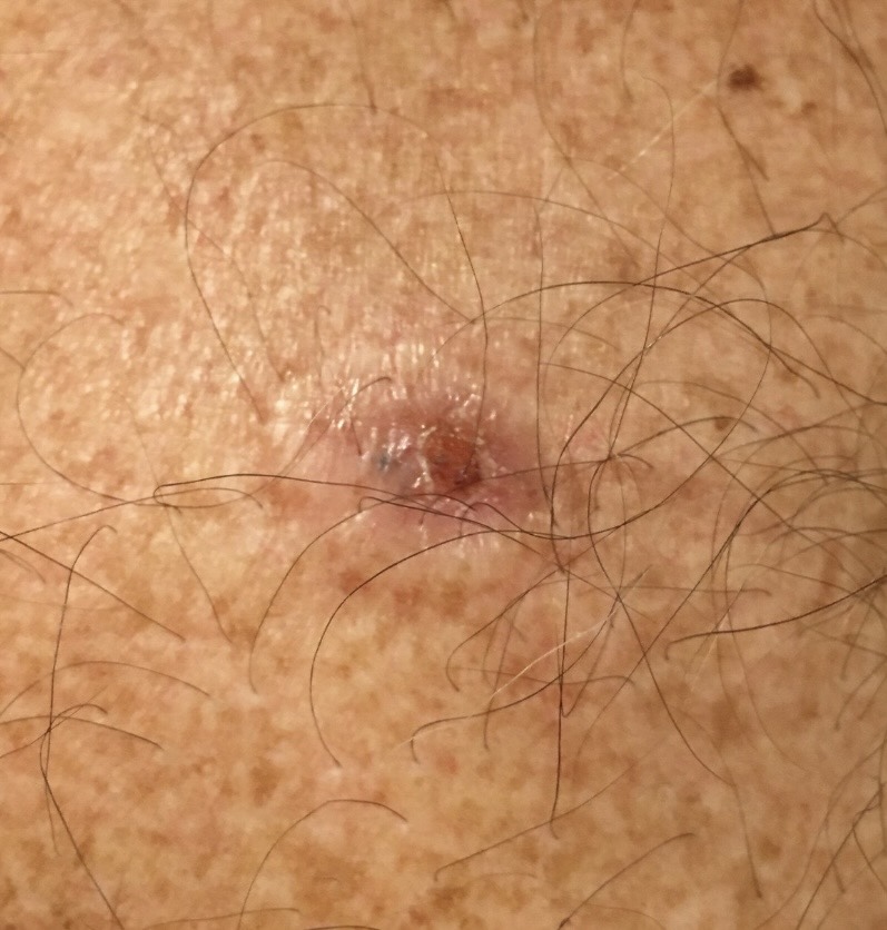 Skin cancer recurrence evaluated at the Kare Skin Cancer Center Santa Monica by board-certified dermatologist Dr. Tiffany Sierro showing a recurrent irregularly pigmented erosive lesion with surrounding erythema and background sun-damaged photodamaged skin consistent with recurrent basal cell carcinoma or squamous cell carcinoma requiring same-day biopsy for histological diagnosis and definitive treatment planning