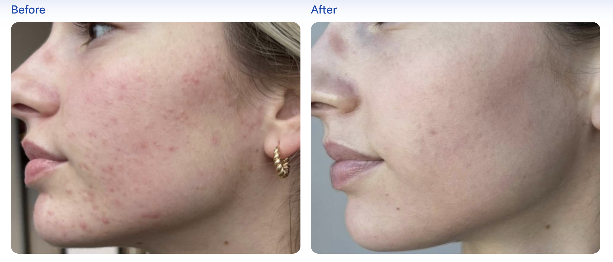 UV Wood's lamp imaging of forehead and upper face melasma at Kare Plastic Surgery Los Angeles showing hyperpigmented patches across forehead periorbital and nasal regions before treatment