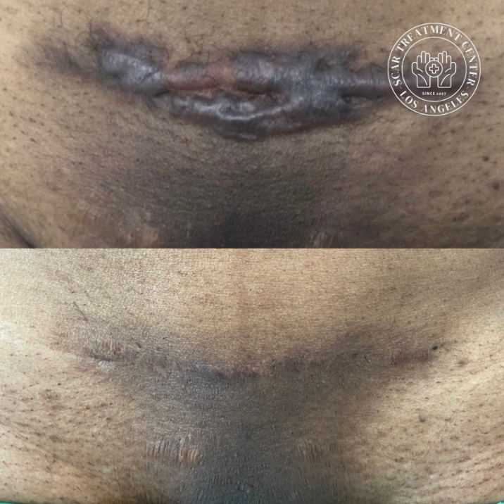 Pubic keloid scar before and after 1 year — long-term low-recurrence result by Dr. Raffy Karamanoukian at Kare Plastic Surgery — LA Scar Treatment Center Los Angeles — keloid near-completely resolved at 1 year post-operatively