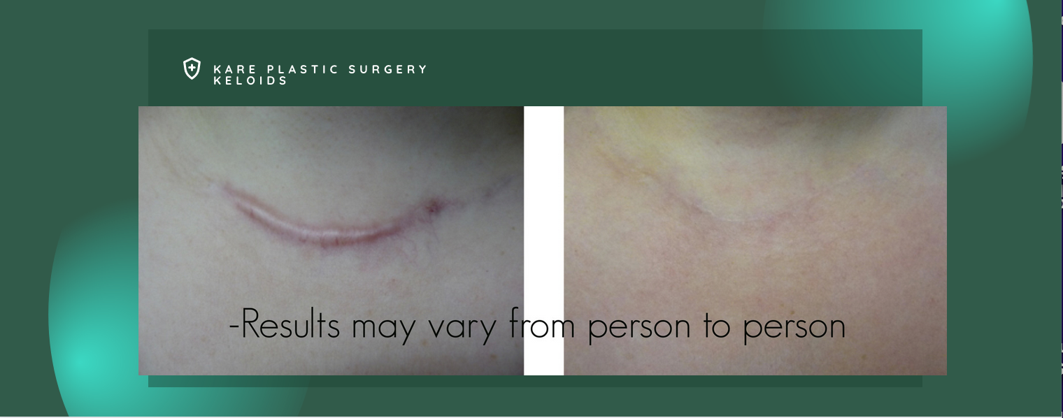 Scar removal keloid surgery in Beverly Hills
