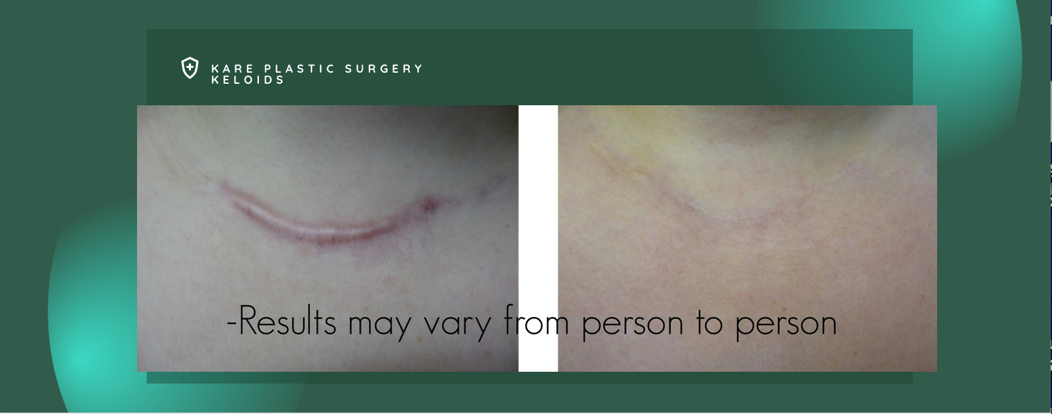 Scar removal keloid surgery in Beverly Hills 