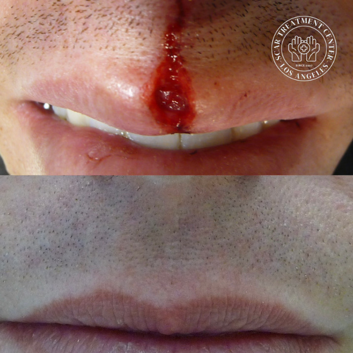 Philtrum laceration before and after repair at Kare Plastic Surgery Los Angeles Scar Treatment Center by Dr. Karamanoukian — full thickness philtrum wound repaired with layered closure showing completely healed invisible scar