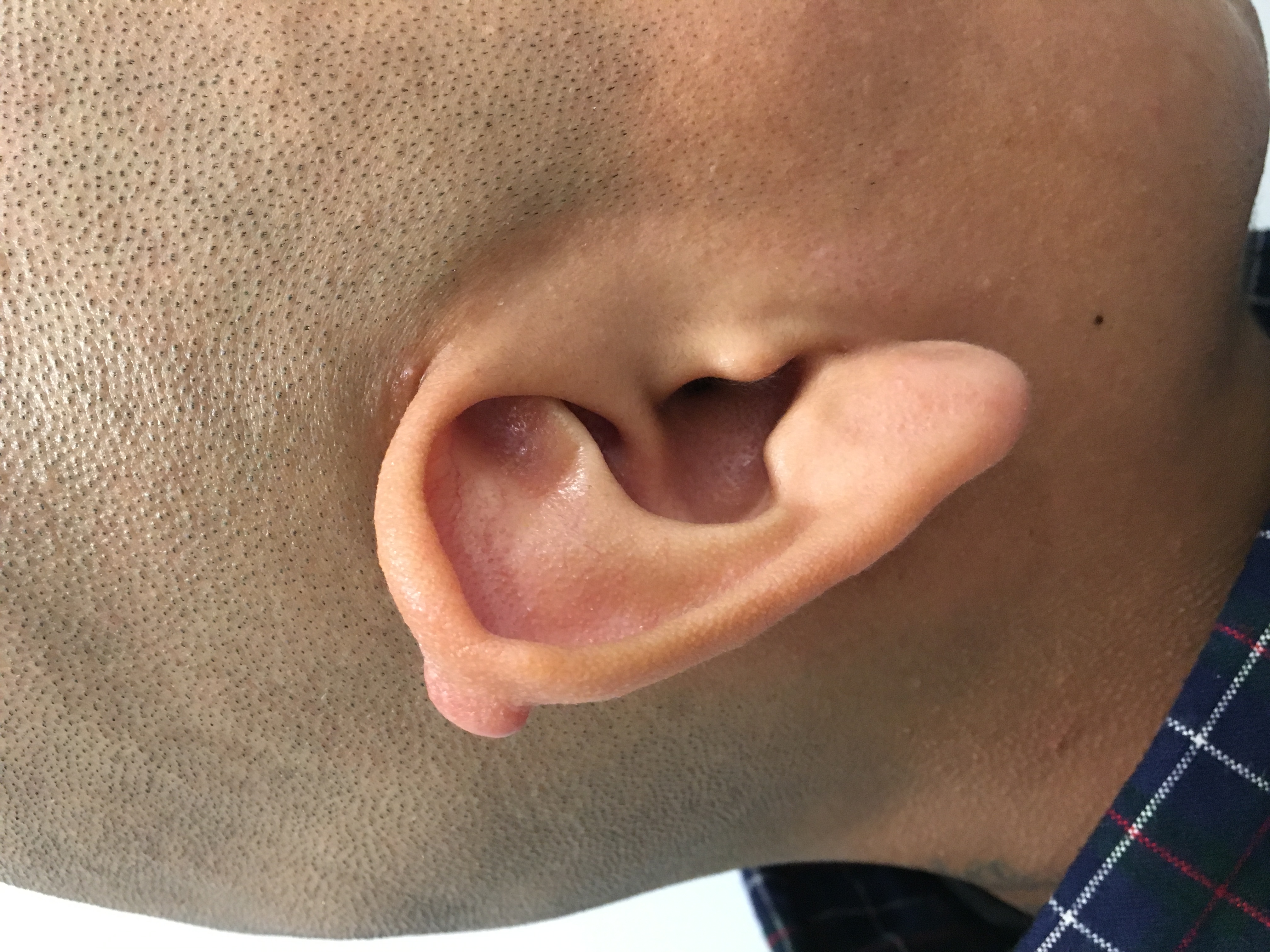 Ear keloid before surgery by Dr. Karamanoukian Los Angeles