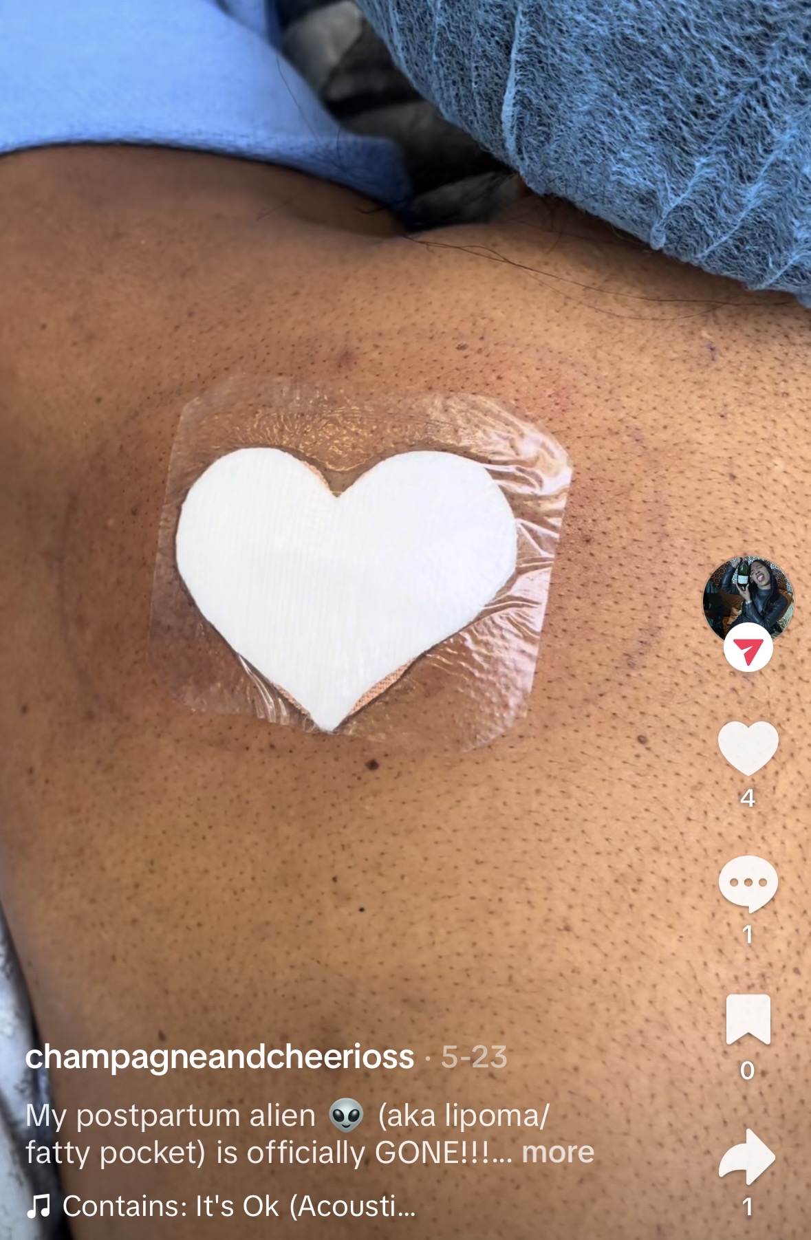 Heart-shaped dressing after minimal scar lipoma removal at Kare Plastic Surgery Los Angeles — immediate post-operative dressing by Dr. Karamanoukian