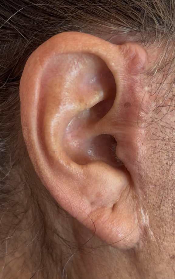 Thick hypertrophic facelift scar treated at Kare Plastic Surgery Los Angeles by board-certified plastic surgeon Dr. Raffy Karamanoukian showing significant postauricular and periauricular scar thickening with raised hypertrophic tissue and abnormal scar architecture following prior facelift surgery requiring surgical scar revision steroid injection and laser treatment