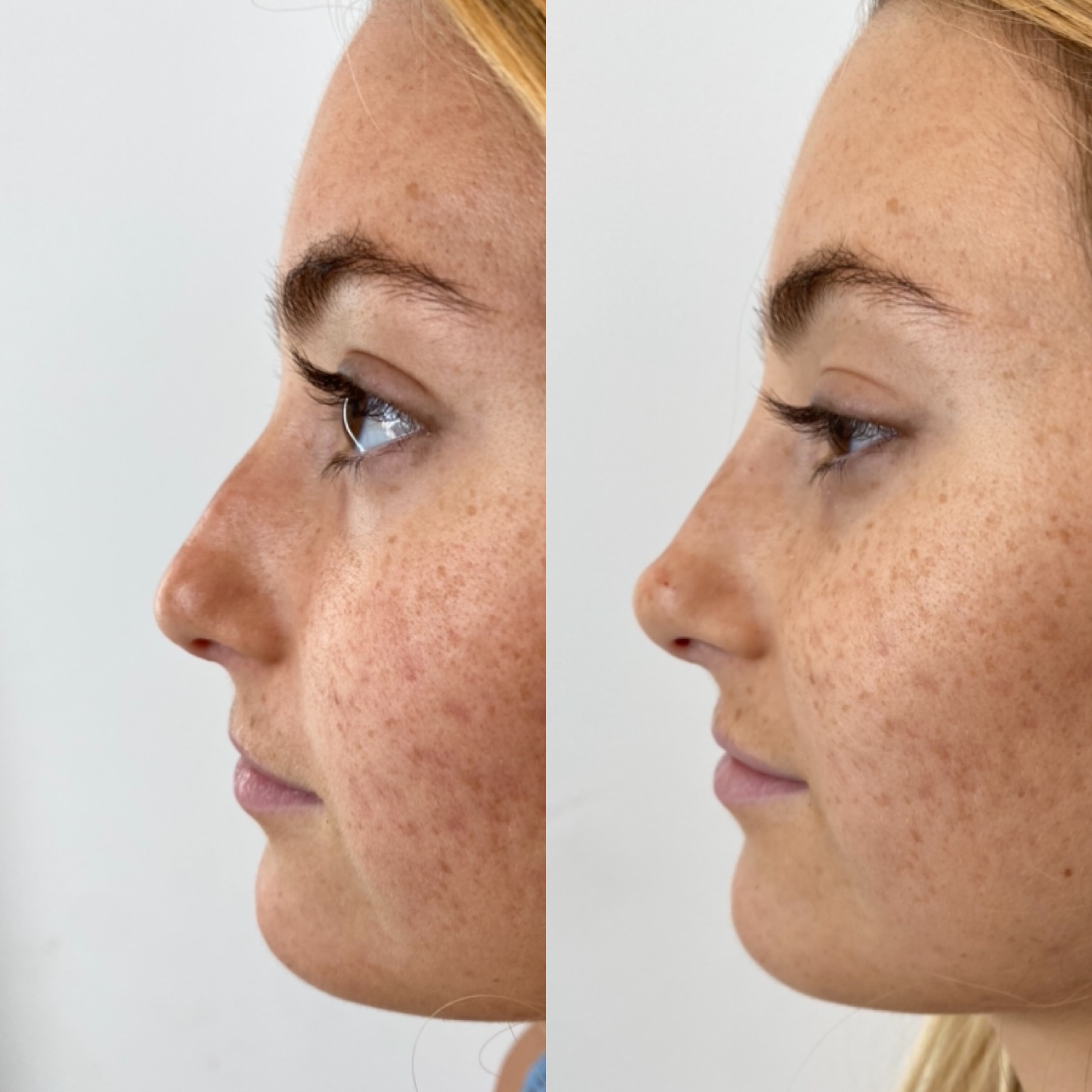 Before and after non-surgical rhinoplasty with nose filler at Kare Plastic Surgery Los Angeles by Dr. Raffy Karamanoukian, showing improved nasal profile and tip elevation using hyaluronic acid filler injection. Individual results vary.