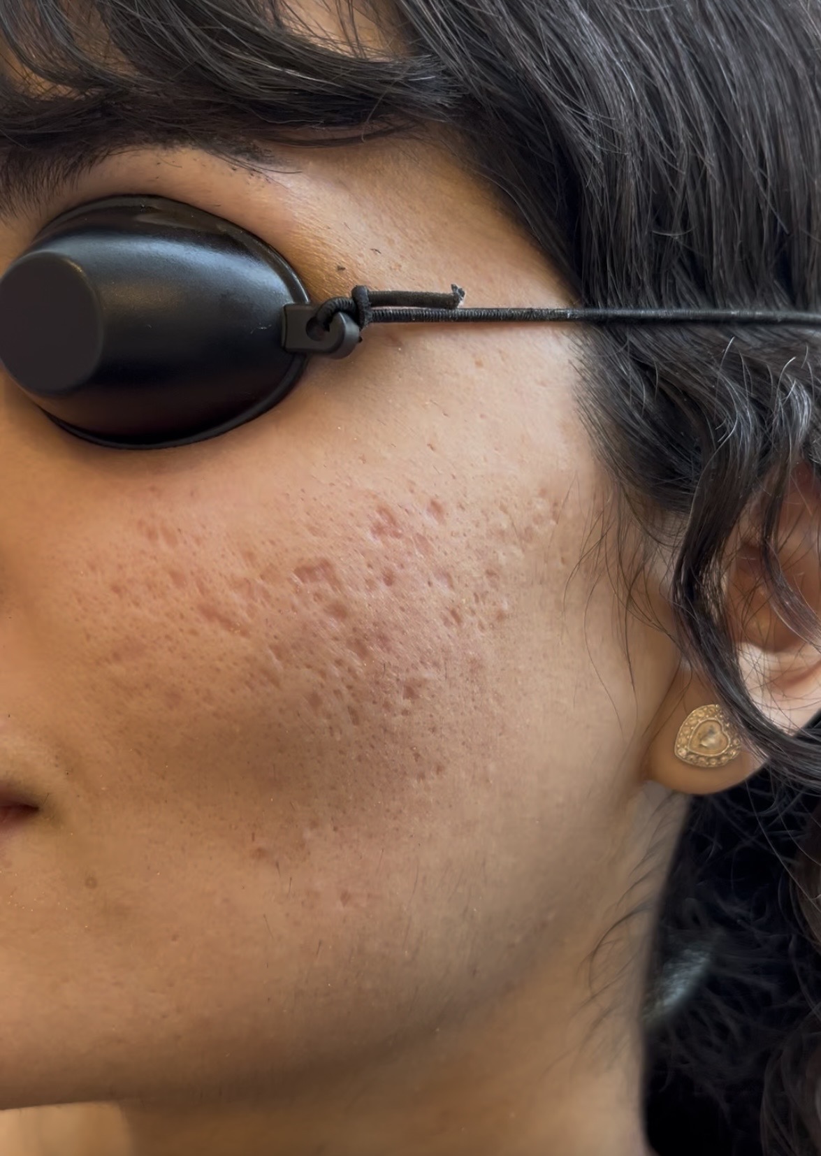 Pre-TCA Cross — acne scars on right cheek before treatment at Kare Plastic Surgery Santa Monica Los Angeles — ice pick and rolling acne scars with post-inflammatory erythema by Dr. Raffy Karamanoukian
