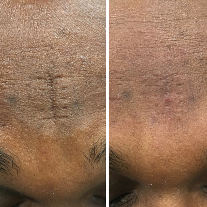 Before and after forehead scar revision in a patient with darker skin tone by Dr. Raffy Karamanoukian at Kare Plastic Surgery Santa Monica Los Angeles — multiple traumatic forehead scars significantly reduced with scar revision treatment