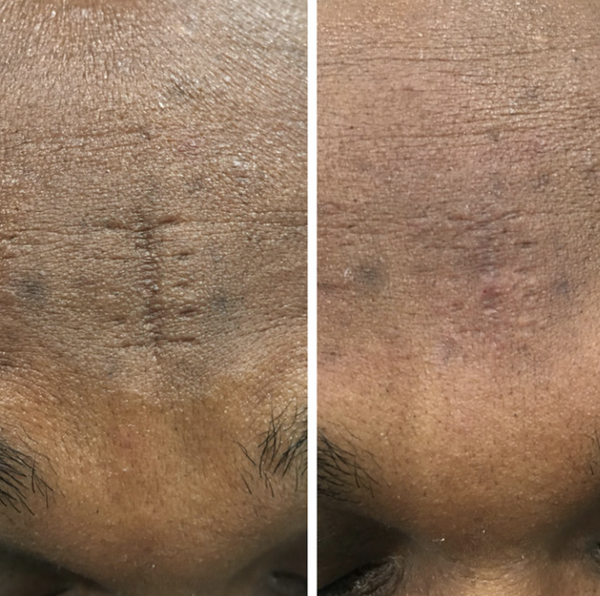 Forehead scar before and after revision at Kare Plastic Surgery Los Angeles by Dr. Karamanoukian — suture track marks and railroad scarring treated in darker skin type