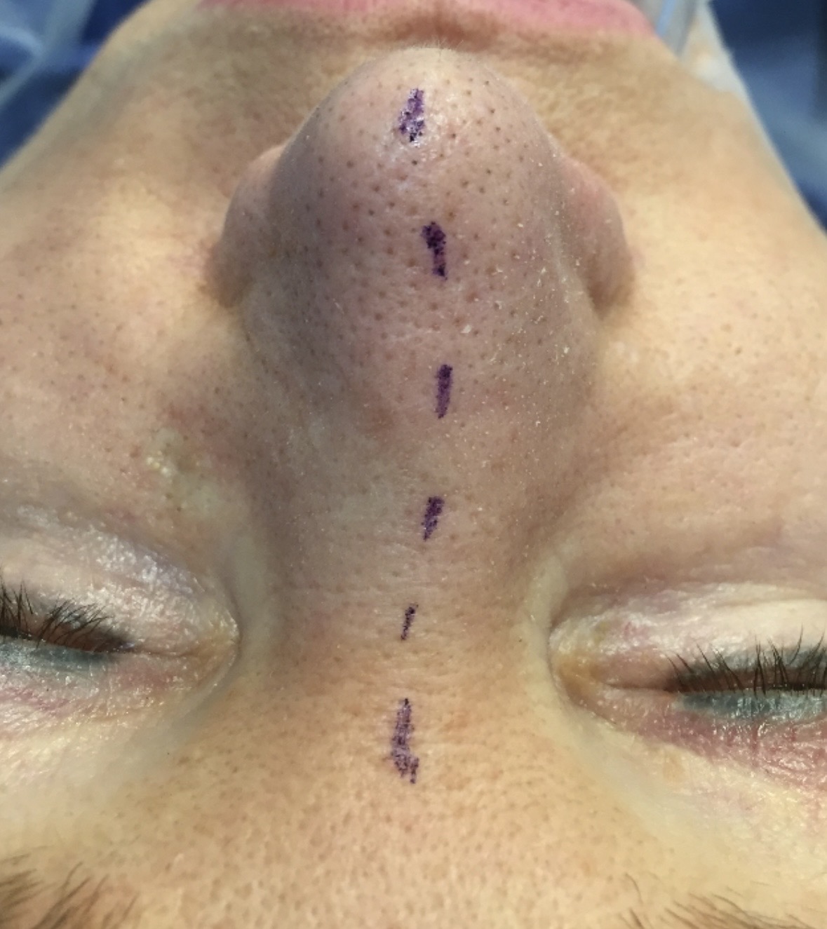 Pre-operative surgical marking for deviated septum repair septoplasty at Kare Plastic Surgery Santa Monica Los Angeles by board-certified plastic surgeon Dr. Raffy Karamanoukian showing columellar midline and dorsal nasal surgical marking with gentian violet dye marking the planned incision sites and structural reference points for open septorhinoplasty approach to correct nasal deviation and nasal airway obstruction