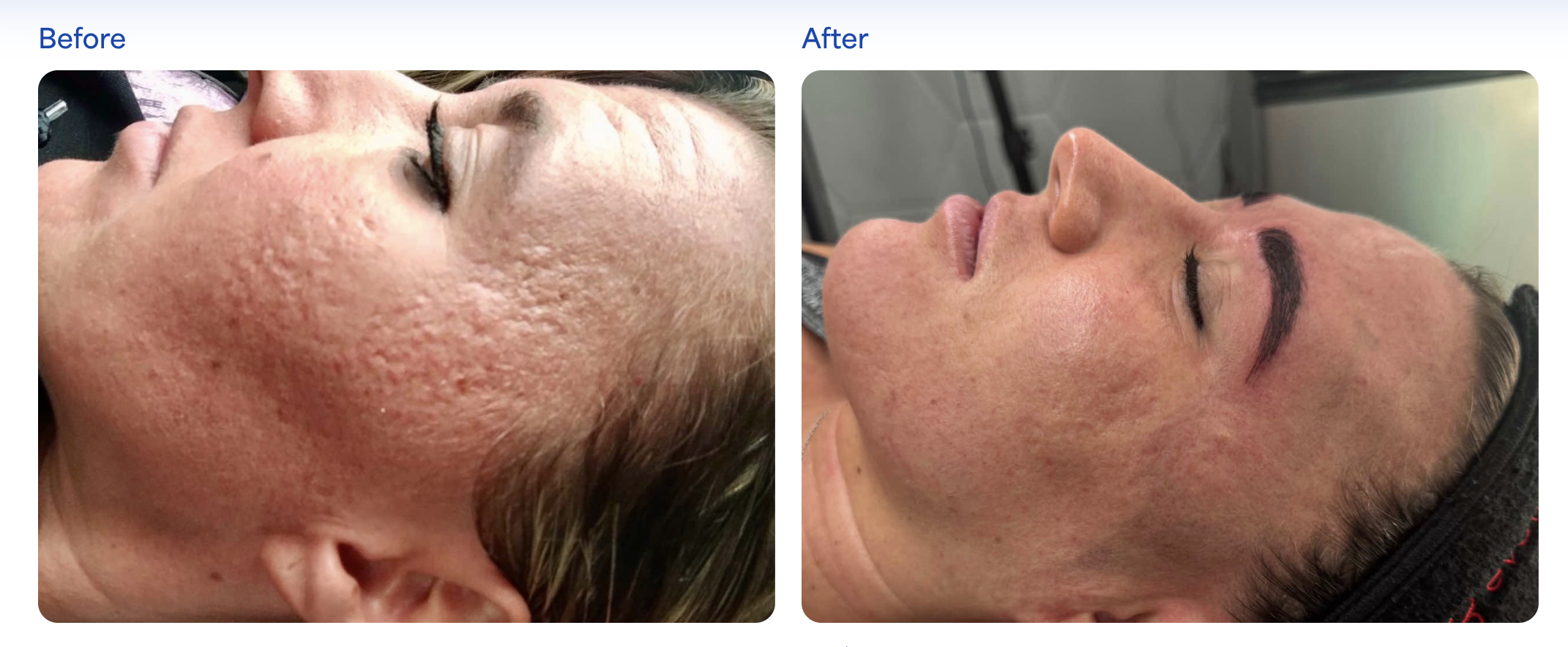 UV Wood's lamp dermatoscopy imaging of severe facial melasma bilateral views at Kare Plastic Surgery Los Angeles by Dr. Karamanoukian showing deep and superficial melanin distribution before skin peel treatment
