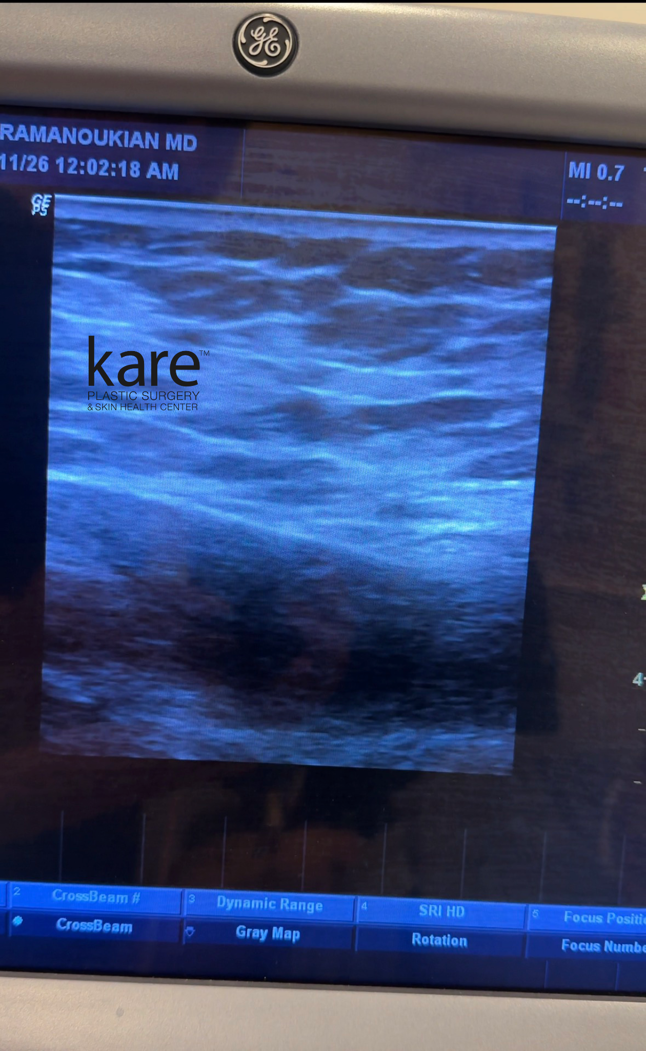 Real-time ultrasound imaging of subcutaneous filler deposit by Dr. Raffy Karamanoukian at Kare Plastic Surgery Los Angeles, showing high-frequency ultrasound guidance used during filler removal to precisely locate and dissolve migrated filler