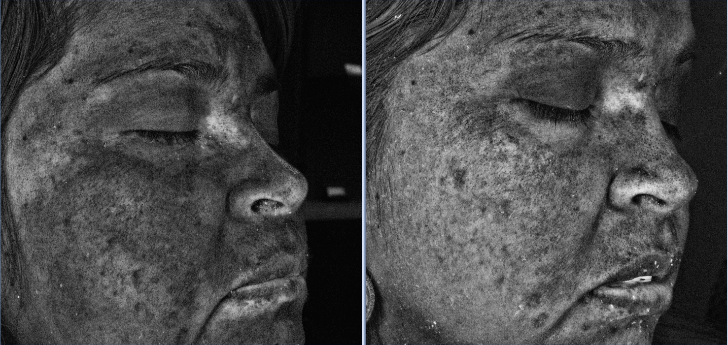 UV Wood's lamp imaging of forehead and upper face melasma at Kare Plastic Surgery Los Angeles showing hyperpigmented patches across forehead periorbital and nasal regions before treatment