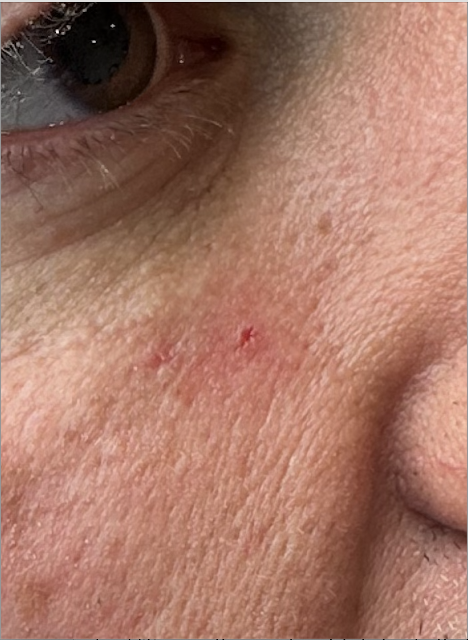 Milia removed at Kare Plastic Surgery Santa Monica — immediate post-extraction showing tiny puncture site with milium completely cleared and no scarring by Dr. Tiffany Sierro