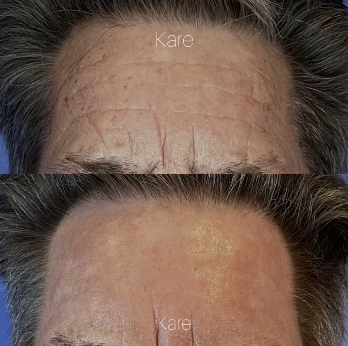 CO2 laser resurfacing before and after — forehead — traumatic scars and skin texture dramatically improved by CO2 fractional laser by Dr. Raffy Karamanoukian at Kare Plastic Surgery Santa Monica Los Angeles