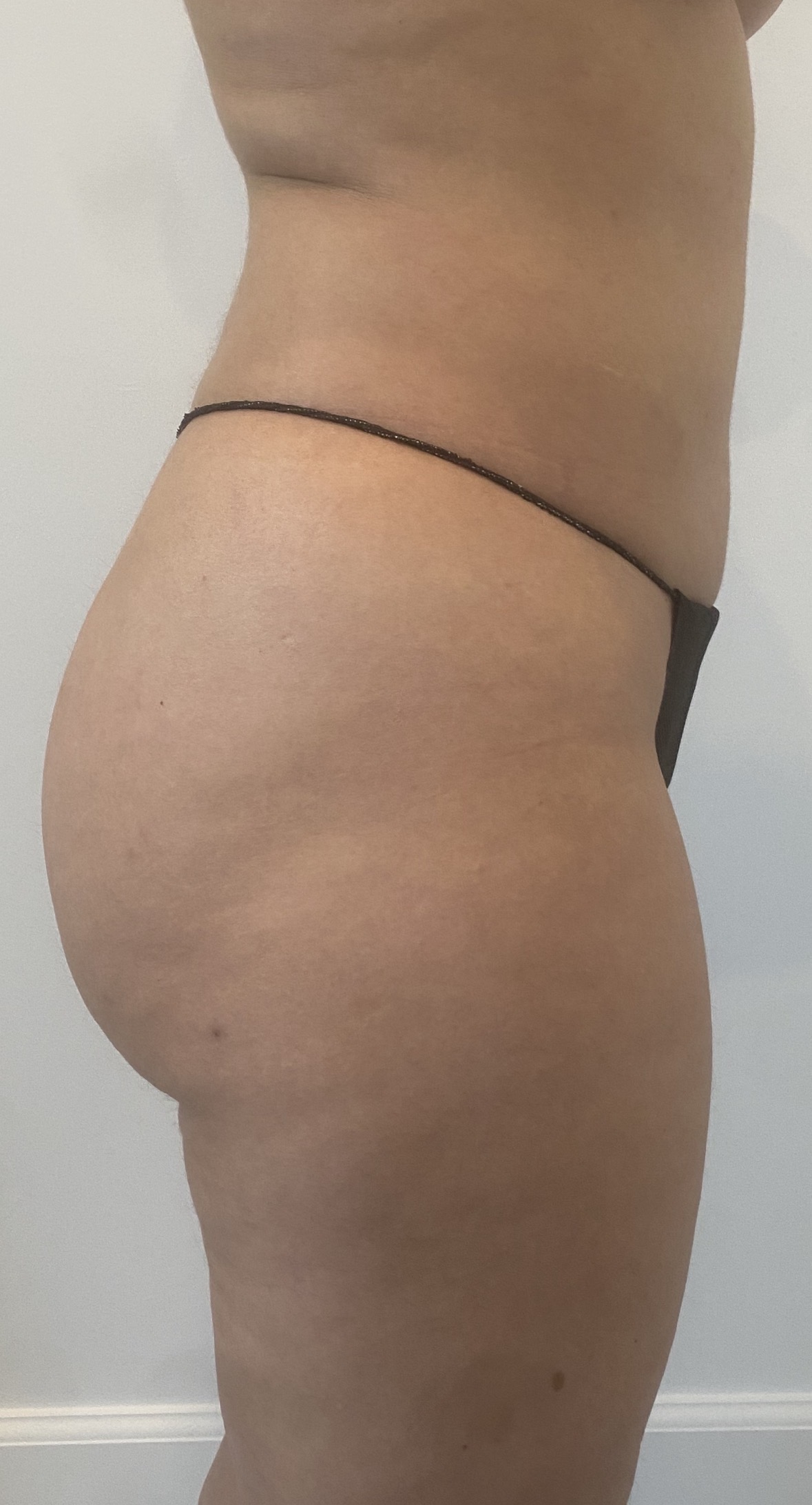 Patient with silicone biopolymer injection complications presenting to Kare Plastic Surgery Los Angeles for evaluation by Dr. Raffy Karamanoukian